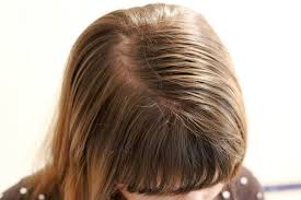 Home Remedies For Oily Hair Fine Oily Hair Greasy Hair Remedies Hair Treatment