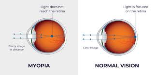 Image result for Myopia