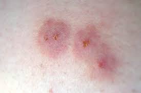 Image result for wolf spider bite skin