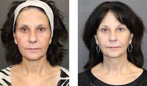 Non-Surgical Procedures in Mentor, OH