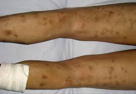 Image result for Panniculitis