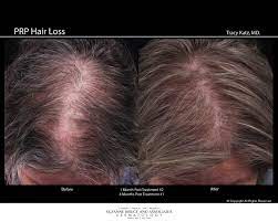 Linville and his team are prepared to help each patient feel comfortable and get them back to feeling like themselves again. New Hair Loss Treatment Prp Dermatology In Houston Texas Suzanne Bruce And Associates