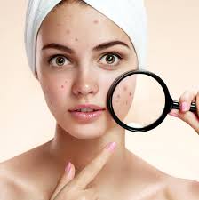 از بین بردن جای جوش صورت موثرترین روش درمان جوش صورت رویکا Home Remedies For Acne Acne Remedies Skin Care Pimples