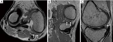 Using a conventional axial image, the coronal plane is prescribed parallel to the pectoralis major muscle (central yellow dotted line) knee muscle anatomy mri. Imaging Evaluation Of The Multiligament Injured Knee Helito Annals Of Joint
