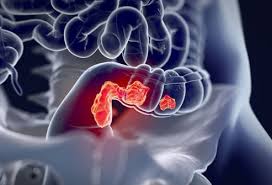 These symptoms are common signs of several other conditions, such as gerd, ibs, and. Rectal Cancer Symptoms Signs Stages Treatment Survival Rate