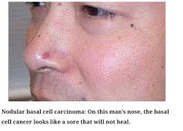 In the uk, around 13,300 people are diagnosed with skin cancer types of treatment can depend on the type of skin cancer, how far it's spread, where the cancer is and what stage it's at. Skin Cancer Associated Dermatology Skin Cancer Clinic