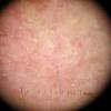 Itchy skin on face and/or hair. 1