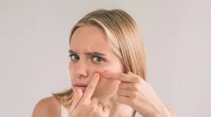 Gimana sih cara mengatasi komedo pada wajah? Cara Menghilangkan Komedo Alami Dari Lemon Hingga Gula Beauty Fimela Com