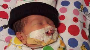 Gratis untuk komersial tidak perlu kredit bebas hak cipta. Bayi Dengan Lubang Di Langit Langit Mulutnya Butuh Rp 1 Juta Per Minggu Ayahnya Mengaku Bingung Tribun Jabar