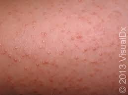 Image result for Keratosis pilaris