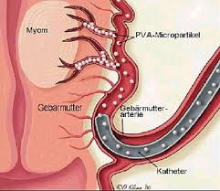Myom rahim kasını meydana getiren hücrelerden gelişen büyümedir. Uterus Myomembolisation Interventionelle Radiologie Leistungsspektrum Methoden Diagnostische Und Interventionelle Radiologie Die Kliniken Diakovere Henriettenstift Diakovere