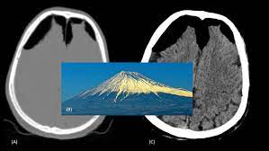 Mt Fuji Sign Axial View A Of A Head Ct Scan On Bone Window There Download Scientific Diagram