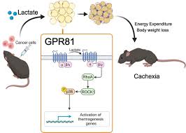 Image result for Cachexia in Cancer
