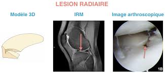 Lésion méniscale isolée/associée à une lésion du lca b. Docteur Bruno Levy Pathologies Meniscales