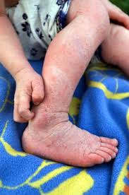 Image result for Neurodermatitis