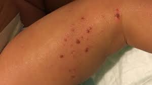 Image result for skin rash similar to scabies