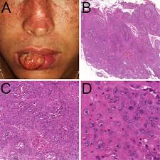 Squamous cell carcinoma most commonly appears on parts of the body frequently exposed to the sun, such as lip cancer is highly curable when diagnosed early. Xeroderma Pigmentosum Variant Squamous Cell Carcinoma Of The Lower Lip Harboring Exon 11 Mutation Of Polh Oral Surgery Oral Medicine Oral Pathology And Oral Radiology