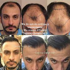 معلومات عن زراعة الشعر بتقنية الاقتطاف في دبي كوسمتك سيرجري حيث تعتبر اكثر التقنيات شهرة في زراعة الشعر في دبي والعالم أثبتت نجاح ملموس وواضح