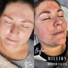 2 more sleeps 🎄 With New Year almost here. Why not treat yourself to a  facial. Take care of the skin your in. Million Dollar Immaculate peels💥 A  chemical peel enhances and
