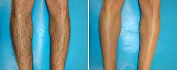 Laser hair removal conveniently located to serve the woodlands, houston, and shenandoah. Laser Hair Reduction At Vedas Medical Spa And Wellness Center