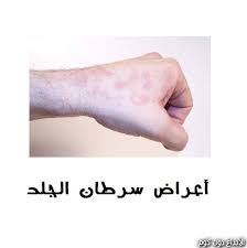 مقال اعراض سرطان المخ السرطان