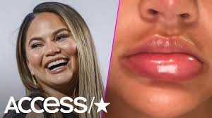 Although she'd been modelling since 2004, it wasn't until 2009 that chrissy—known back then as christine teigen… Chrissy Teigen S Massively Swollen Lip Was About To Explode For This Alarming Reason Youtube