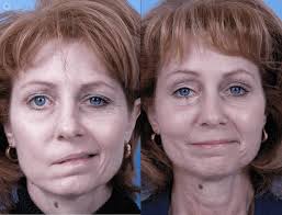 Bell's palsy before and after. Everything About Bell S Palsy News Dentagama