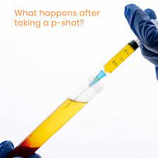 What actually happens during and after the P-shot procedure? | Metromale  Clinic & Fertility Center