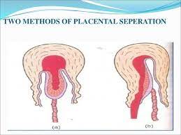 What are the signs and symptoms of placental abruption? Third Stage Of Labour Ppt Download