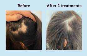 Again, in her opinion, she said it was probably brought on with the onset of the disease and/or the weight loss which caused stress. Steroid Injections For Hair Loss Fact Sheet And Definitive Guide