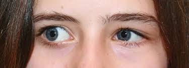 Schielen Auge Online