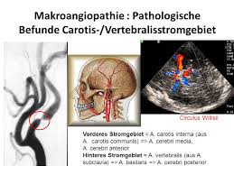 Zerebrovaskulare Erkrankungen Ppt Video Online Herunterladen