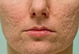 Image result for acne face