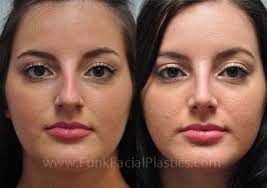 Rhinoplasty For A Bulbous Tip Wide Nasal Tip Surgery Funk Facial Plastic Surgery Bulbous Nose Rhinoplasty Facial Plastic