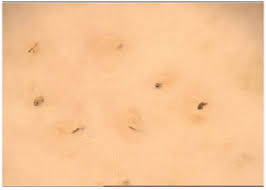 Furuncles and carbuncles are the medical names for what you would call a boil. Alopecia Areata Incognita Yellow Dots Can Be Observed Within The Download Scientific Diagram