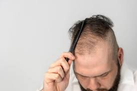 Image result for Alopecia