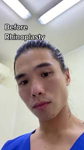 Transformation: Rhinoplasty Before and After