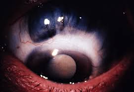 Er Can Be Mild Or Severe Alkali Tends To Penetrate The Cornea More Rapidly And Cause More Severe Corneal A Conjunctivitis Ulcer Causes Streptococcal Infection