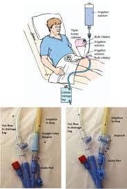 Continuous Bladder Irrigation Cbi Flashcards Quizlet