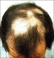 Lamisil may be used alone or with other medications. Diagnosing And Treating Hair Loss American Family Physician