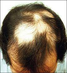 The most common side effects of terbinafine hydrochloride include: Diagnosing And Treating Hair Loss American Family Physician