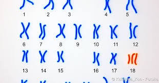 Trisomie 18 Symptome Folgen Ursachen Therapie Netdoktor