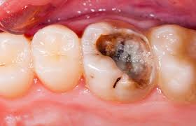 Generally speaking, you should just eat soft food for the first few days after your procedure. Best Root Canal Treatment Naperville Painless Dental Care
