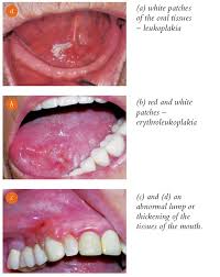 Image result for white cancer on tongue)