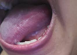 Image result for white cancer on tongue)