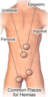 Image result for Inguinal hernia man