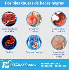 Cirujanos Del Aparato Digestivo Las Heces Negras Por Lo Regular Son El Resultado De Sangre Proveniente De La Parte Superior Del Tracto Gastrointestinal Solo Que Con Apariencia De Alquitran Tras Haberse