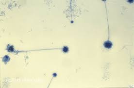 Blootstelling aan aspergillus fumigatus bij mensen met een verminderd immuunsysteem kan aspergillose veroorzaken, een infectie van de long. Aspergillus Fumigatus Altmeyers Encyclopedia Department Dermatology