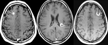 Multiple sclerosis (ms) is a condition that can affect the brain and spinal cord, causing a wide range of potential symptoms, including problems with vision, arm or leg movement, sensation or balance. Esclerosis Multiple