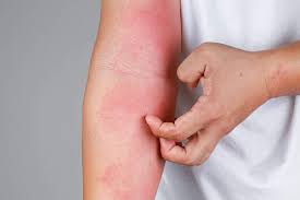 Image result for Rhus Dermatitis